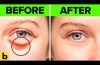 17 Easy Home Remedies To Get Rid Of Under Eye Bags
